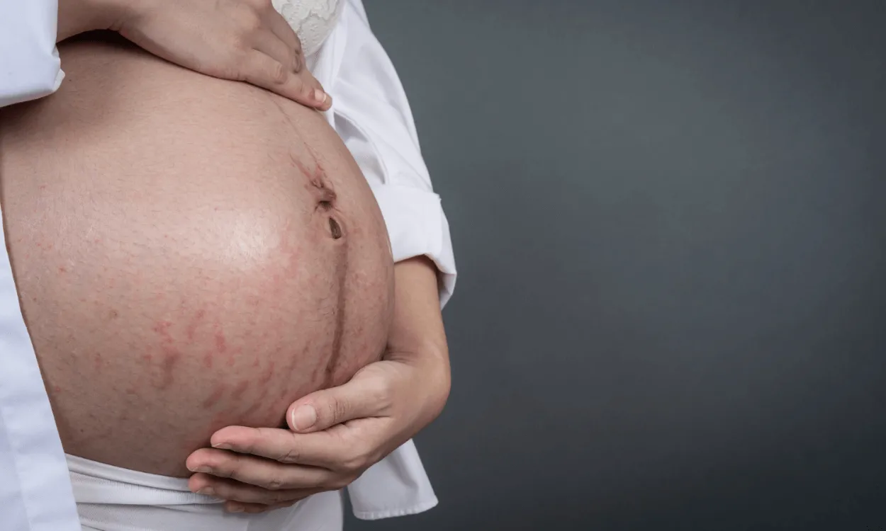 Pancione con cloasma