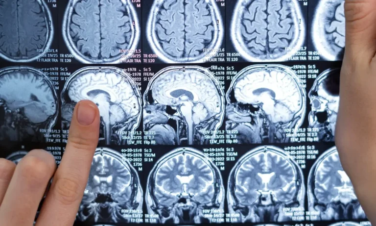 Qual è lo stato dell’arte della neuroriparazione